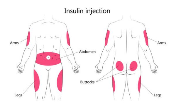 Insulin Injection Sites: Optimize Your Diabetes Management